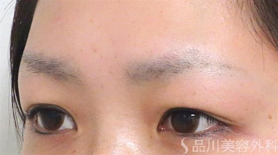 症例NO.26989のBEFORE写真