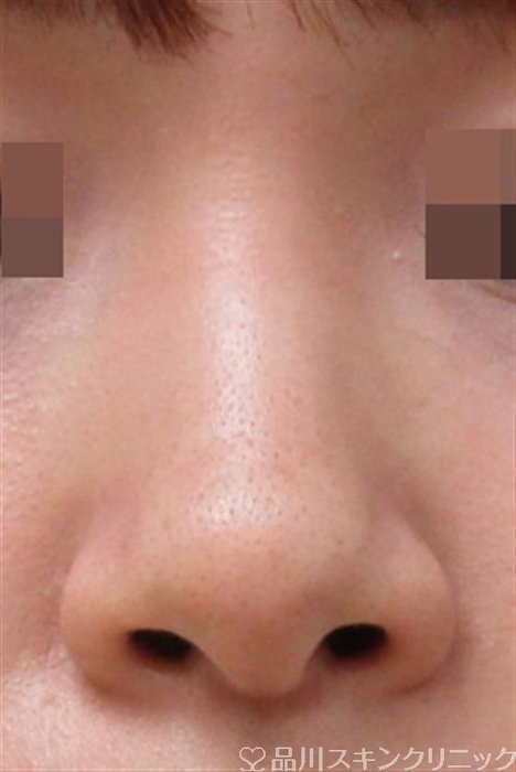 症例NO.32232のBEFORE写真
