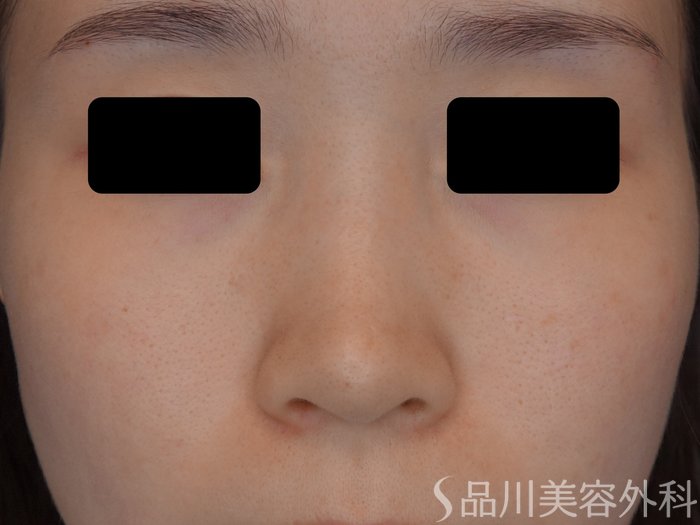 症例NO.74962のBEFORE写真