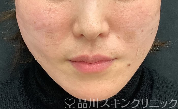 症例NO.69484のAFTER写真