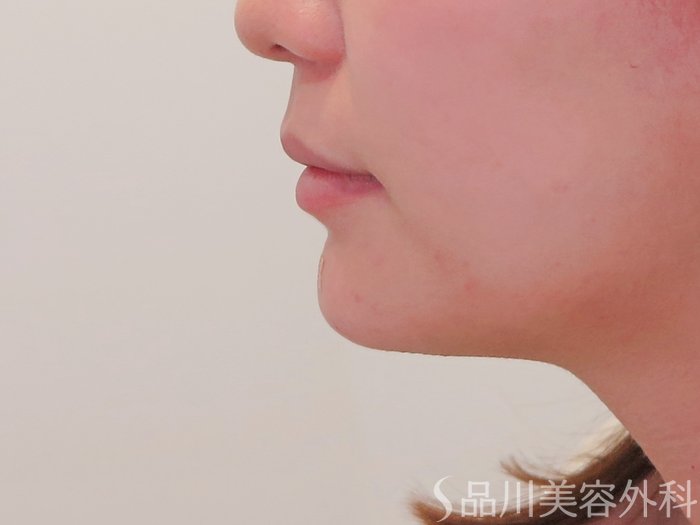 症例NO.69716のAFTER写真