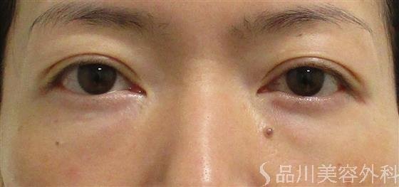 症例NO.59150のBEFORE写真