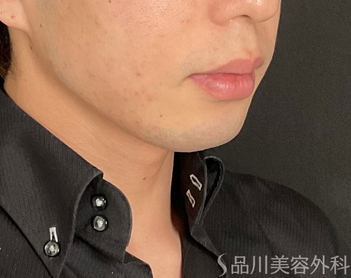 症例NO.74573のBEFORE写真