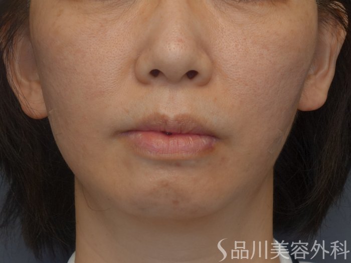 症例NO.74135のAFTER写真