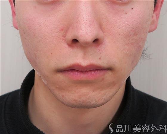 症例NO.46115のAFTER写真