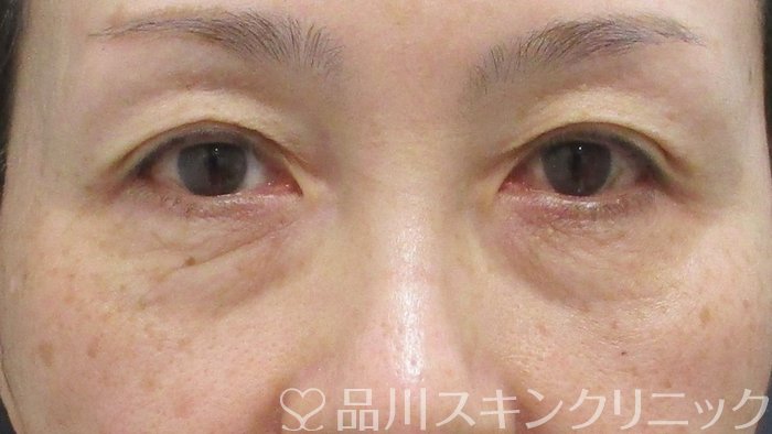 症例NO.69892のBEFORE写真