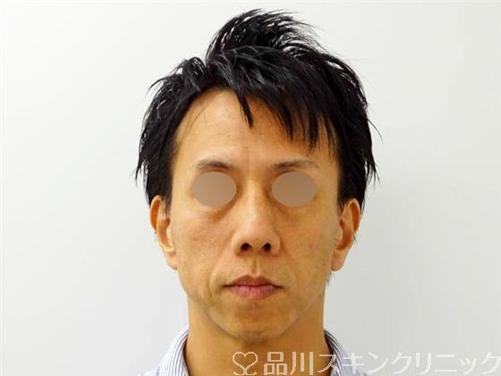 症例NO.49251のBEFORE写真