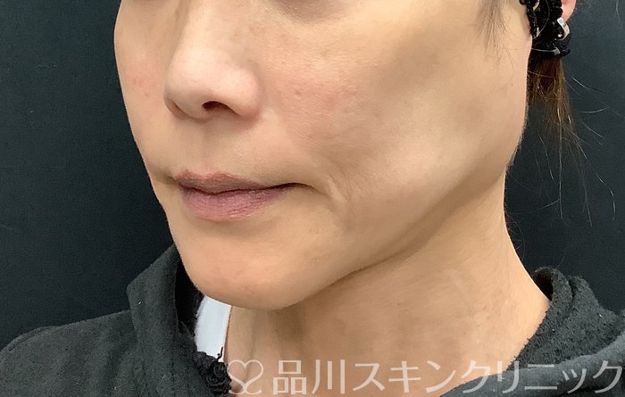 症例NO.71108のBEFORE写真