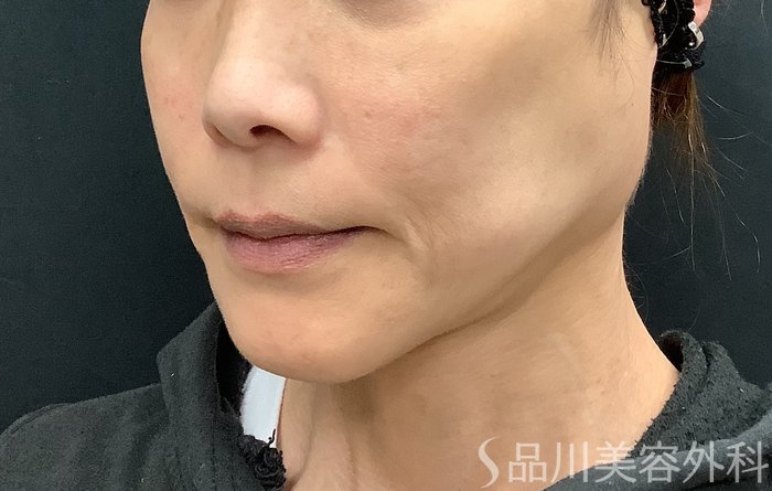 症例NO.71108のBEFORE写真