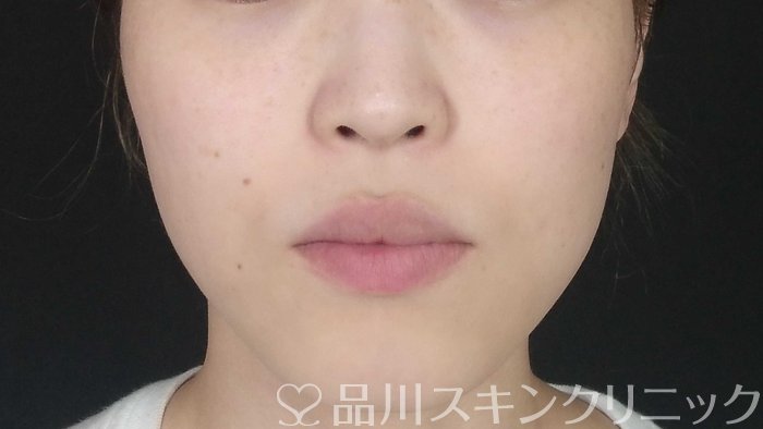 症例NO.71414のBEFORE写真