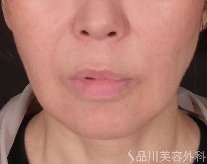 症例NO.70084のBEFORE写真