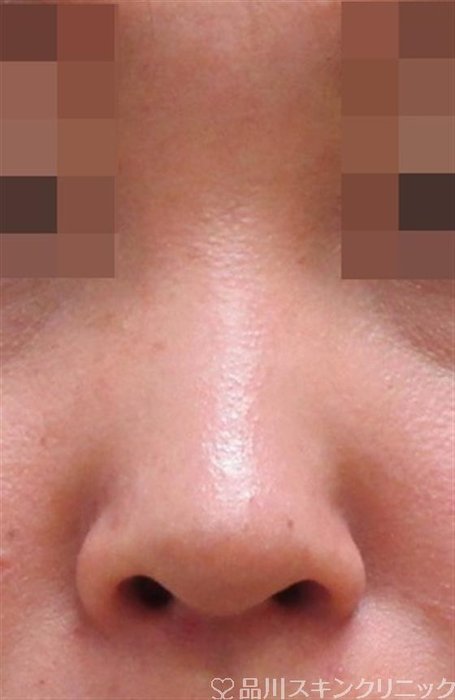 症例NO.32659のBEFORE写真