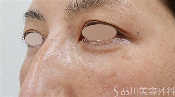 症例NO.50882のAFTER写真