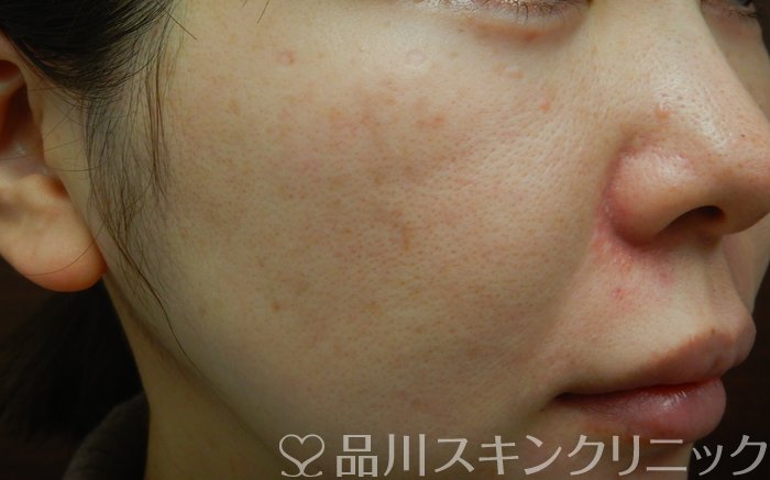 症例NO.66481のBEFORE写真