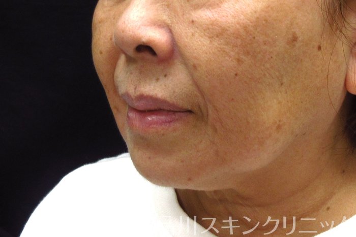 症例NO.74582のBEFORE写真