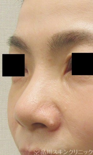 症例NO.69373のBEFORE写真