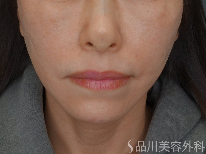 症例NO.73951のBEFORE写真