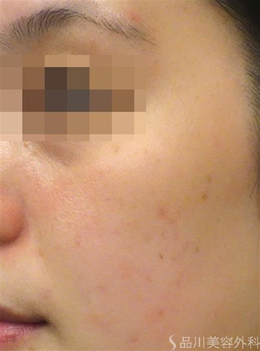 症例NO.25257のAFTER写真