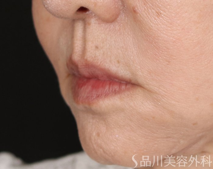 症例NO.70885のBEFORE写真