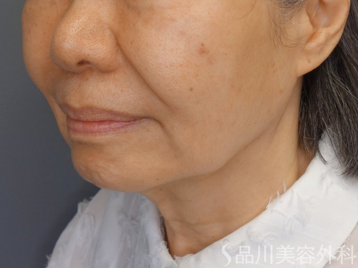 症例NO.70101のBEFORE写真