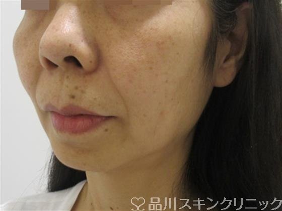 症例NO.37769のBEFORE写真