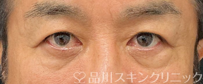 症例NO.74818のBEFORE写真
