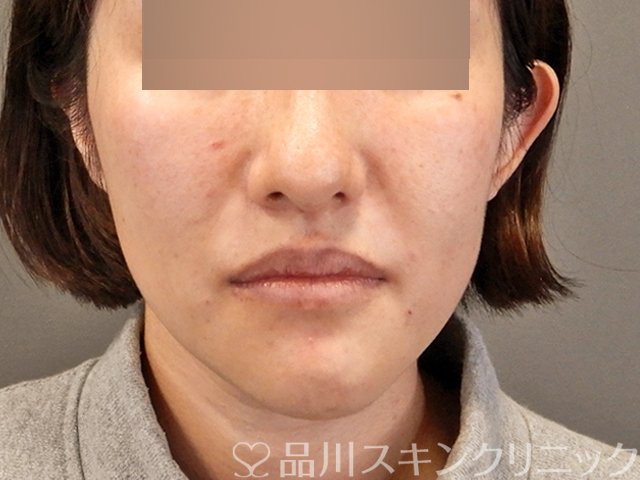 症例NO.69998のAFTER写真