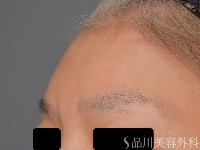症例NO.70706のAFTER写真