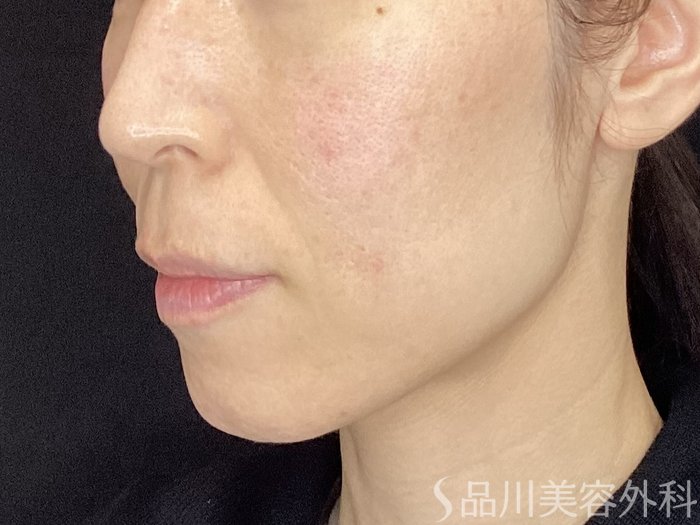 症例NO.72126のBEFORE写真