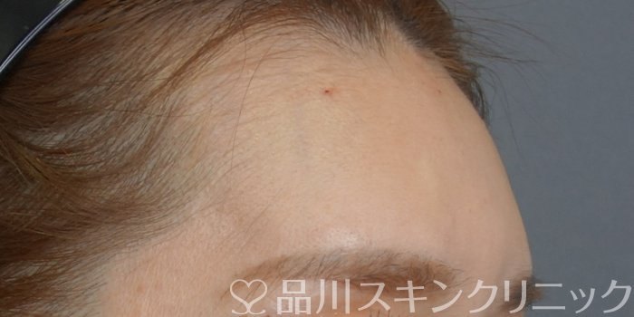 症例NO.74027のAFTER写真