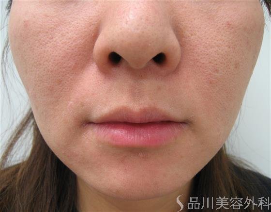 症例NO.27819のBEFORE写真