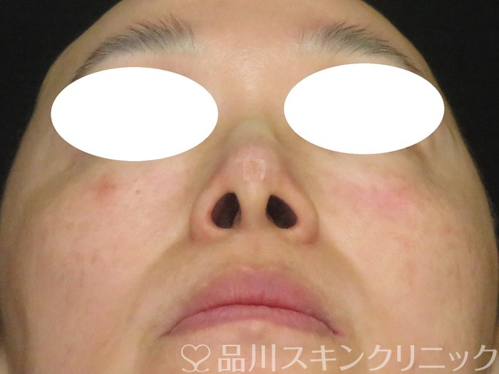 症例NO.70136のAFTER写真
