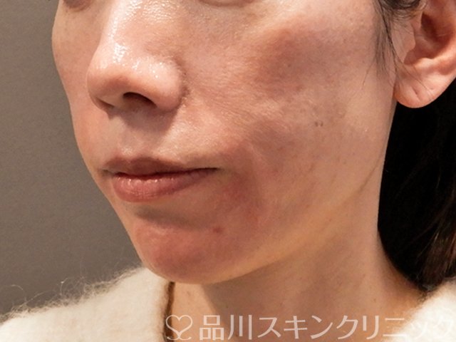 症例NO.69825のAFTER写真