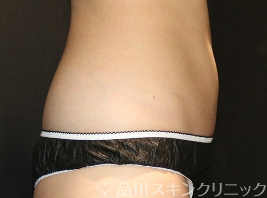症例NO.74382のAFTER写真