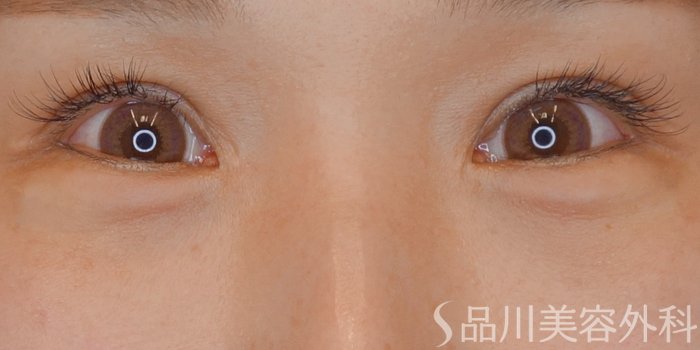 症例NO.71925のAFTER写真