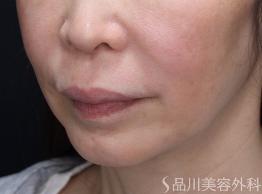 症例NO.73110のBEFORE写真