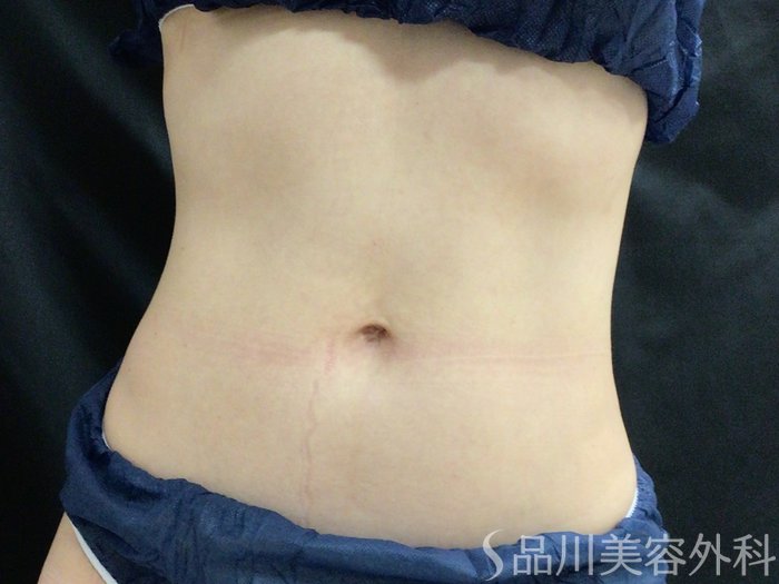 症例NO.69544のAFTER写真