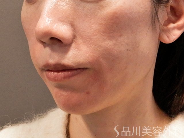症例NO.69825のAFTER写真