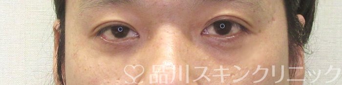症例NO.71038のAFTER写真