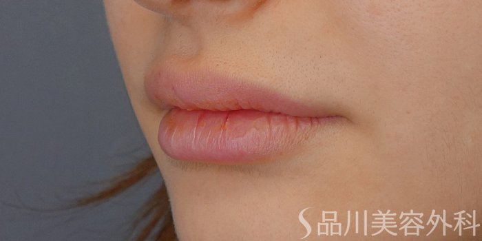 症例NO.72422のBEFORE写真