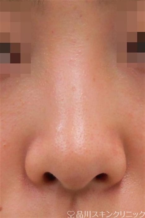 症例NO.34780のBEFORE写真