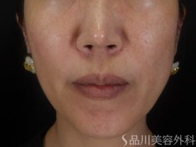 症例NO.74306のAFTER写真