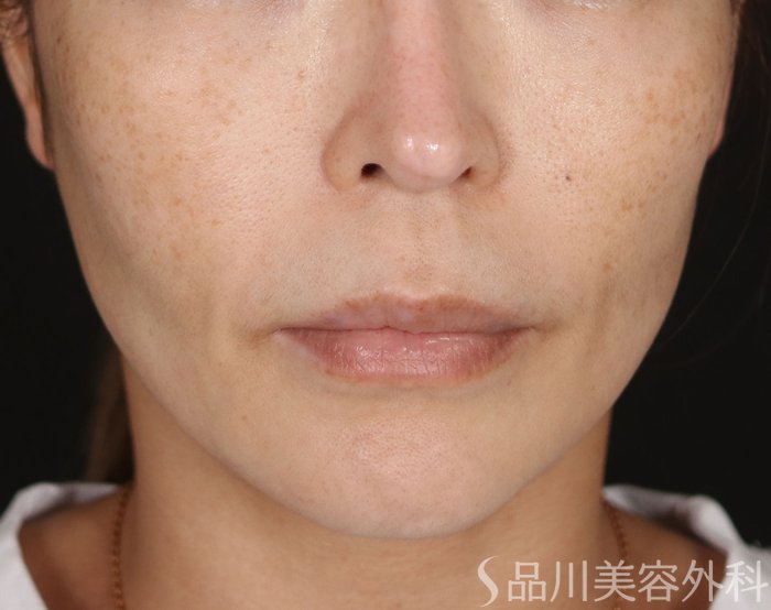 症例NO.74092のBEFORE写真