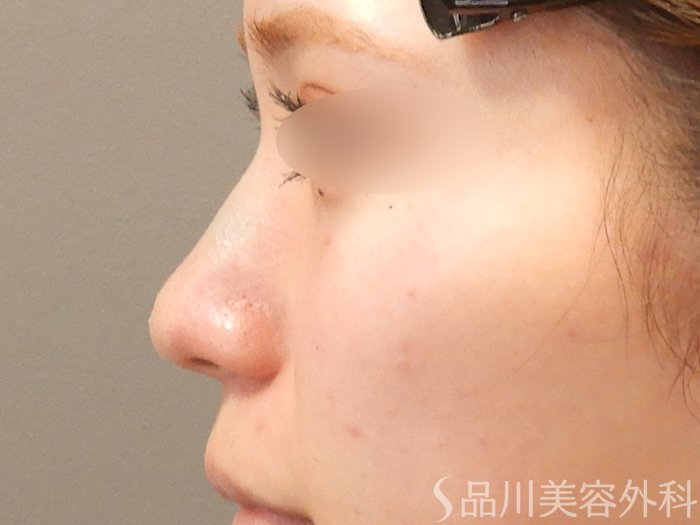 症例NO.70794のAFTER写真