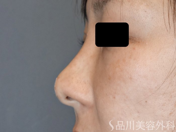 症例NO.72949のAFTER写真