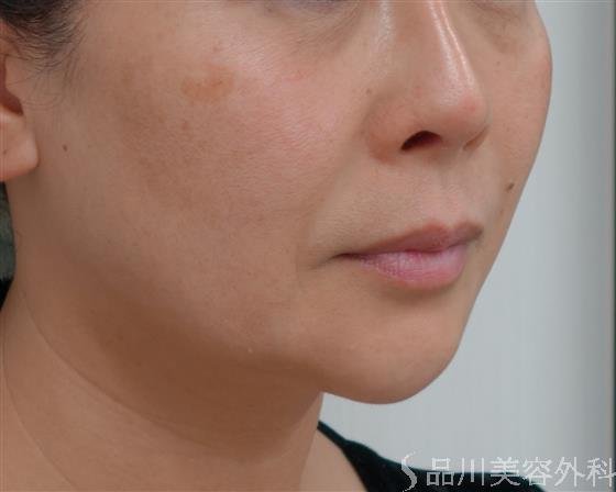 症例NO.37396のBEFORE写真