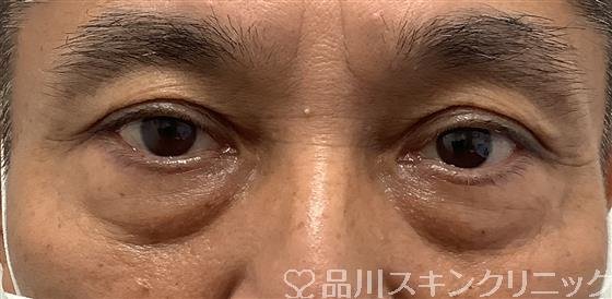 症例NO.61656のBEFORE写真