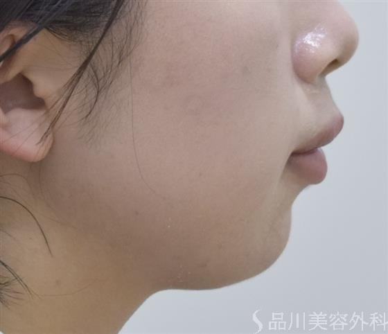 症例NO.46844のAFTER写真