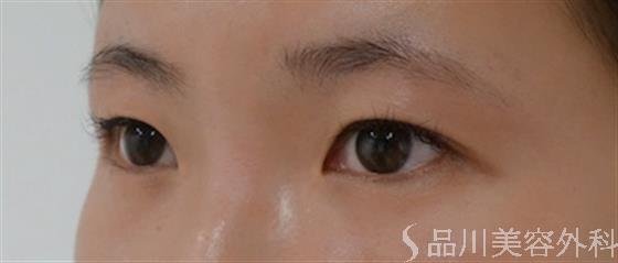 症例NO.27894のBEFORE写真