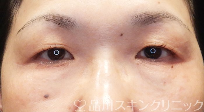 症例NO.72128のBEFORE写真